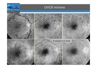 Occlusions vasculaires retiniennes