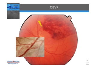 Occlusions vasculaires retiniennes