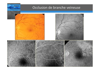 Occlusions vasculaires retiniennes
