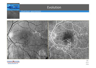 Occlusions vasculaires retiniennes