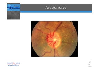 Occlusions vasculaires retiniennes