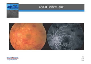 Occlusions vasculaires retiniennes