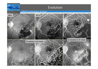 Occlusions vasculaires retiniennes