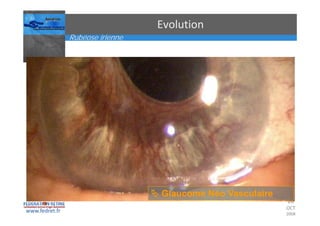 Occlusions vasculaires retiniennes