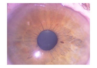Occlusions vasculaires retiniennes