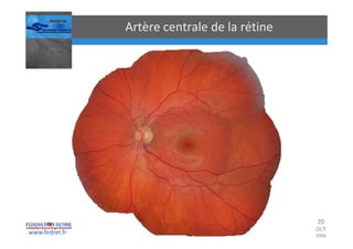 Occlusions vasculaires retiniennes