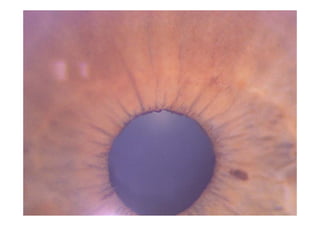 Occlusions vasculaires retiniennes