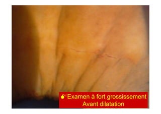 Occlusions vasculaires retiniennes