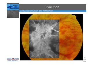 Occlusions vasculaires retiniennes