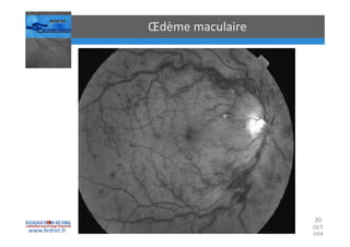 Occlusions vasculaires retiniennes