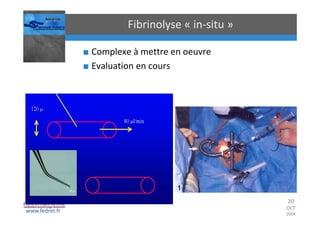 Occlusions vasculaires retiniennes