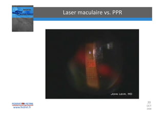 Occlusions vasculaires retiniennes