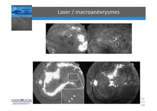 Occlusions vasculaires retiniennes