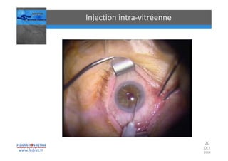 Occlusions vasculaires retiniennes