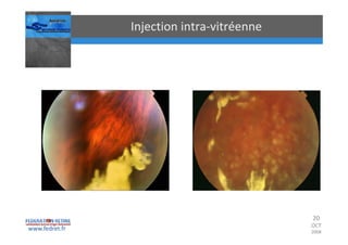 Occlusions vasculaires retiniennes