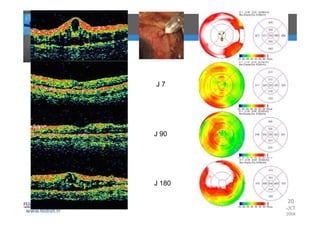 Occlusions vasculaires retiniennes