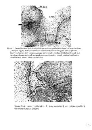 8
Figure 2 : Dédoublement de la lame primitive en lame vestibulaire (l.vest) et lame dentaire
(l.dent) en regard de la condensation du mésenchyme odontogène (més.od) flèche ;
Embryon humain de 7 semaines, coupe transversale,. Ep.buc: épithélium buccal; m.b:
membrane basale; més.md : mésenchyme mandibulaire; os.md: travée d'ossification
mandibulaire: s.vest : sillon vestibulaire.
Figure 3 : A : Lame vestibulaire – B : lame dentaire, à son voisinage activité
mésenchymateuse (flèche)
 