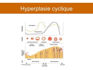 Hyperplasie cyclique 