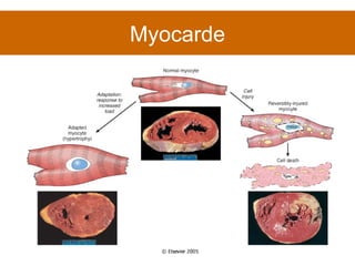 Myocarde 