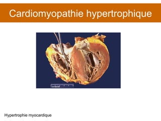 Cardiomyopathie hypertrophique Hypertrophie myocardique 