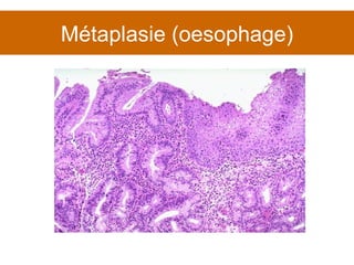 Métaplasie (oesophage) 