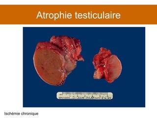 Atrophie testiculaire Ischémie chronique 