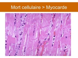 Mort cellulaire > Myocarde 