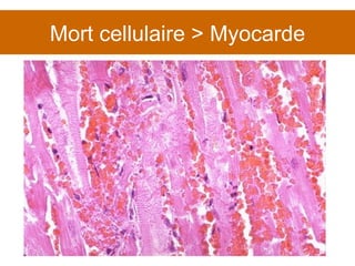 Mort cellulaire > Myocarde 