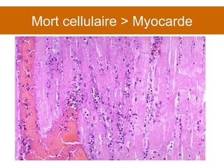 Mort cellulaire > Myocarde 