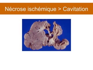 Nécrose ischémique > Cavitation 