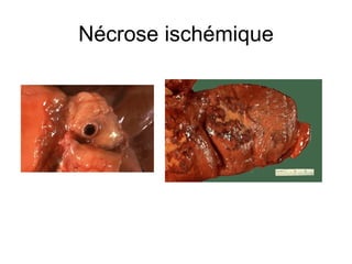 Nécrose ischémique 