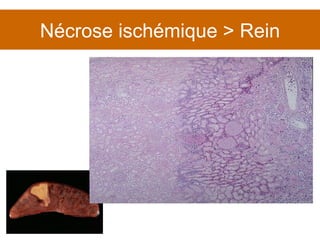 Nécrose ischémique > Rein 