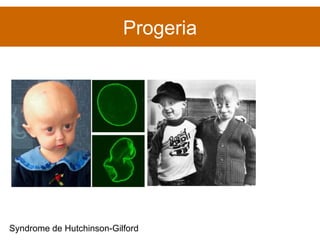 Progeria Syndrome de Hutchinson-Gilford  