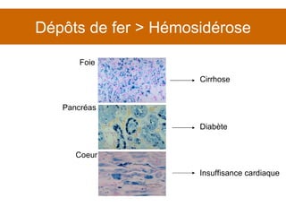 Dépôts de fer > Hémosidérose Foie Pancréas Coeur Cirrhose Diabète Insuffisance cardiaque 