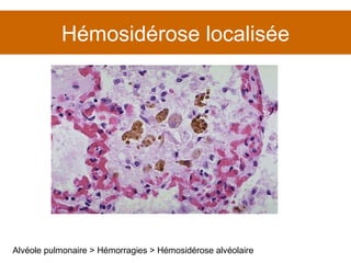 Hémosidérose localisée Alvéole pulmonaire > Hémorragies > Hémosidérose alvéolaire 
