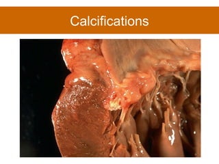 Calcifications 