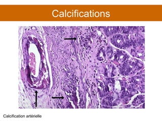 Calcifications Calcification artérielle 