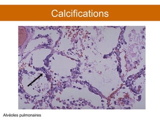 Calcifications Alvéoles pulmonaires 