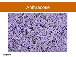 Anthracose Tabagisme 