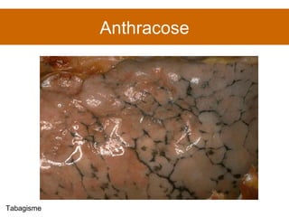 Anthracose Tabagisme 