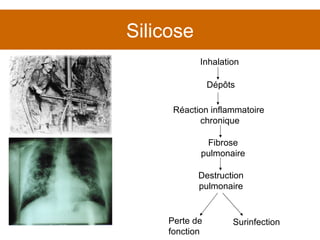 Silicose Inhalation Dépôts Réaction inflammatoire  chronique Fibrose pulmonaire Destruction pulmonaire Perte de fonction Surinfection 