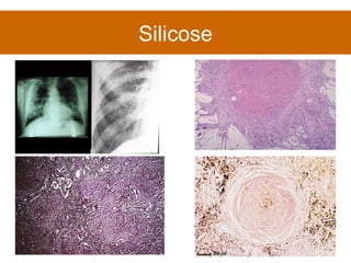 Silicose 