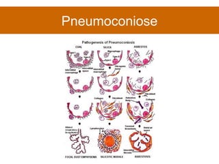 Pneumoconiose 