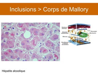 Inclusions > Corps de Mallory Hépatite alcoolique 