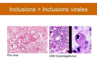 Inclusions > Inclusions virales Pox virus CMV Cytomégalovirus 
