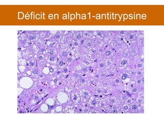 Déficit en alpha1-antitrypsine 