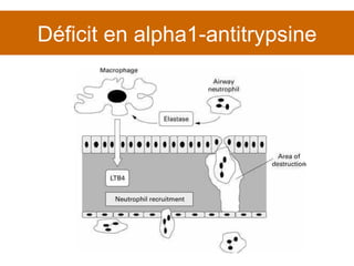 Déficit en alpha1-antitrypsine 