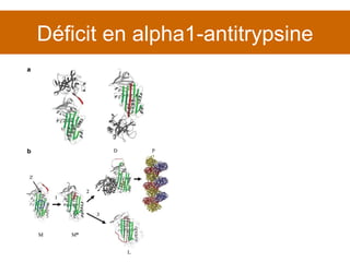 Déficit en alpha1-antitrypsine 