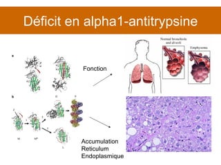 Déficit en alpha1-antitrypsine Fonction Accumulation Reticulum Endoplasmique 