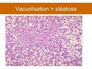 Vacuolisation > stéatose 